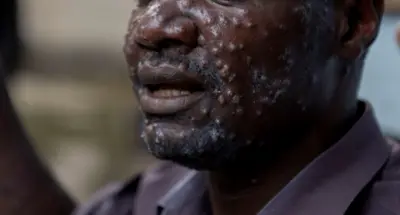 Un patient recevant un traitement contre le mpox le virus provoque une éruption cutanée douloureuse, une hypertrophie des ganglions lymphatiques et de la fièvre.