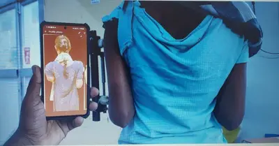 பெண்ணுக்கு 14 செ.மீ. எலும்பை வளரவைத்து அரசு மருத்துவர்கள் சாதனை