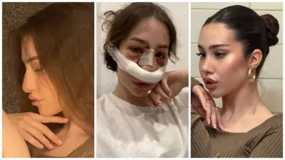 Три фотографии молодой девушки: слева до операции, в центре - сразу после операции, справа - с уже зажившим носом новой формы