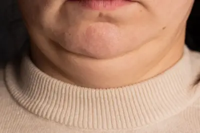Foto mostrando uma pessoa do lábio inferior até a base do pescoço. A pele do pescoço está um pouco flácida. Ela está vestindo um suéter creme de gola careca.