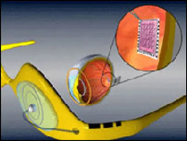 técnica do olho biônico