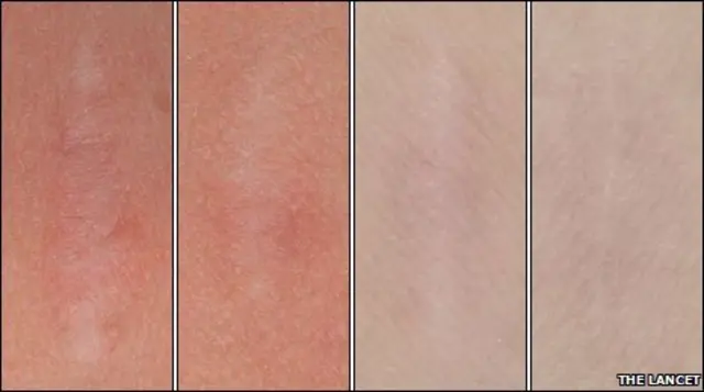 Imagen de cicatrices tratadas con avotermin y placebo (The Lancet)