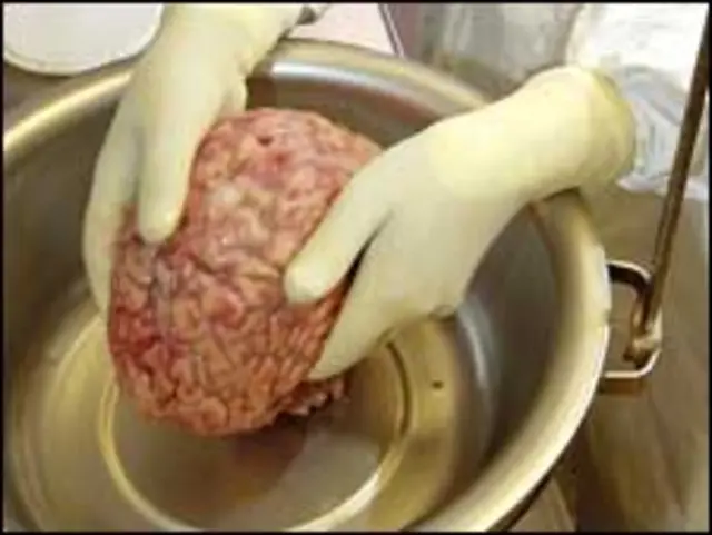 حافظے کی کمزوری دماغ میں خلیوں میں زبردست کمی کے سبب ہوتی ہے