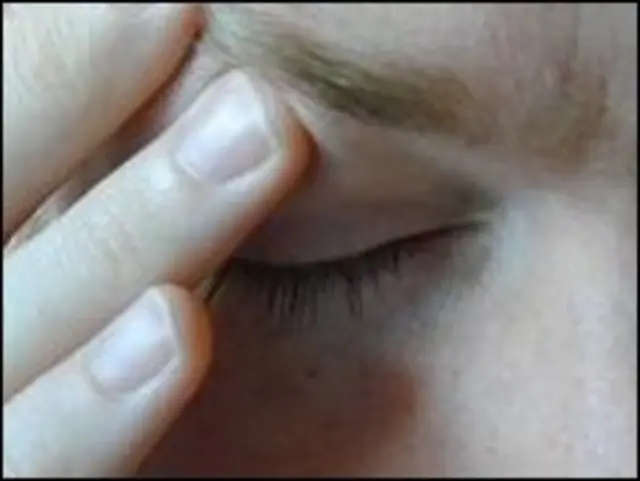 ایک اندازے کے مطابق برطانیہ میں سات لاکھ افراد میگرین کے مرض میں مبتلا ہیں