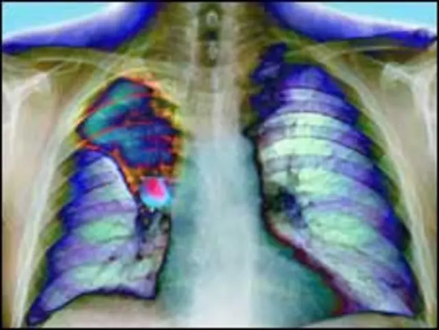 फेफड़े के कैंसर से हर साल तेरह लाख लोगों की मौत होती है