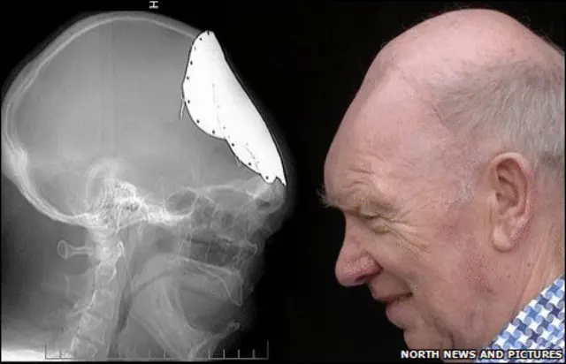 Arte mostra raio-x do crânio e foto da cabeça de Moore