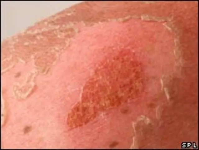 小时候晒的皮肤起泡，日后发生皮肤癌的可能性就会增加。