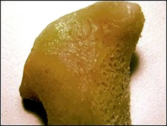 जबड़े की हड्डी