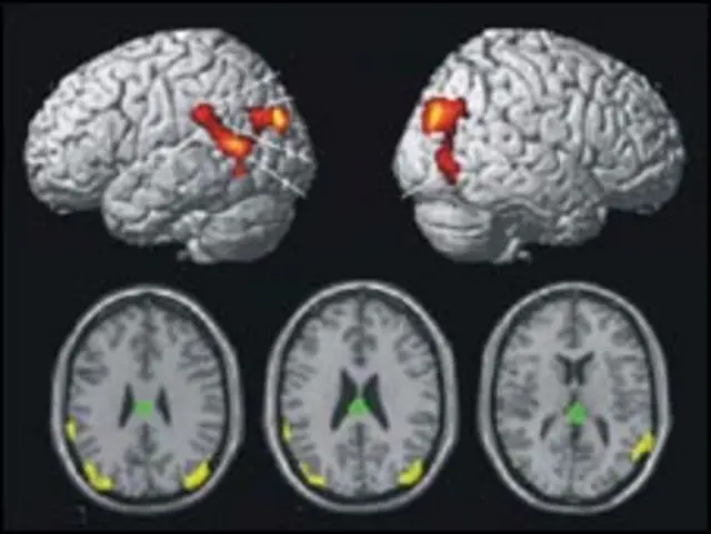 मस्तिष्क के सिकुड़ने से भी अलज़ाइमर्स जैसी बीमारी होती है.