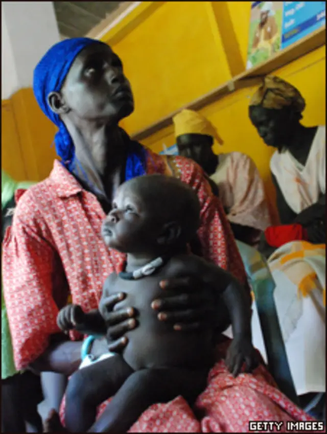 سيدة تحمل ابنها الذي يعاني من سوء التغذية في جنوب السودان