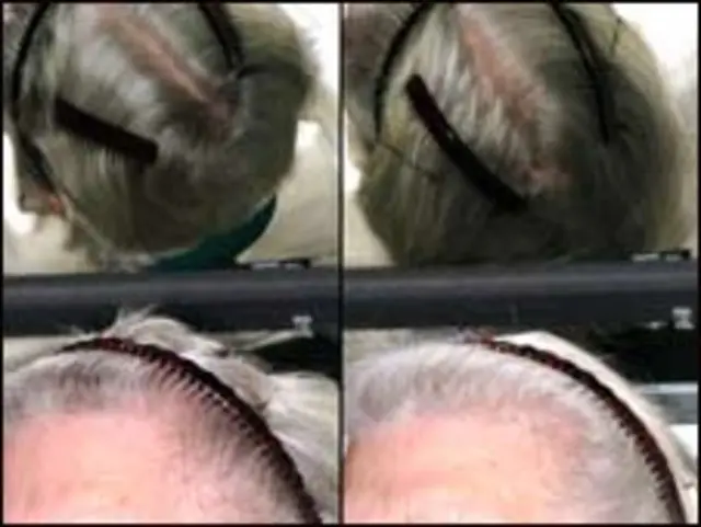 جوڑواں بہنوں کے سر کی فوٹو