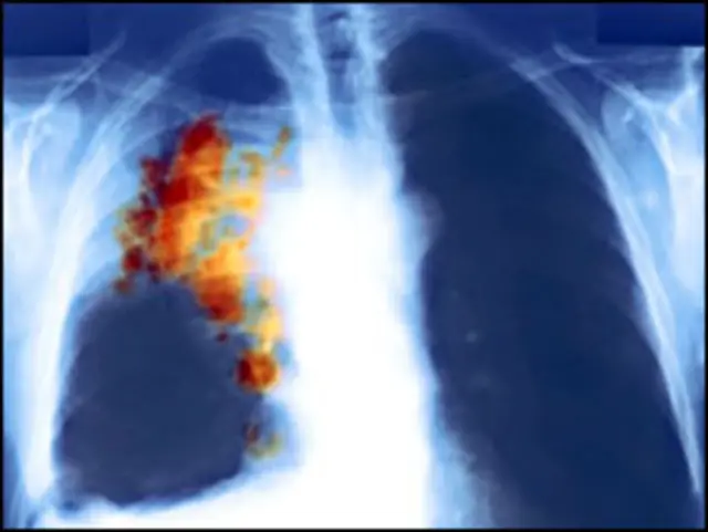 Рентген легкого