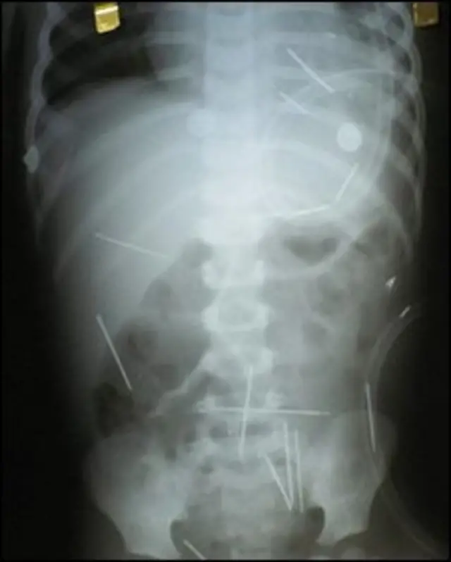 Рентгеновский снимок