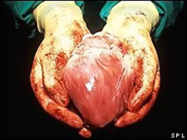 Corazón donado para trasplante