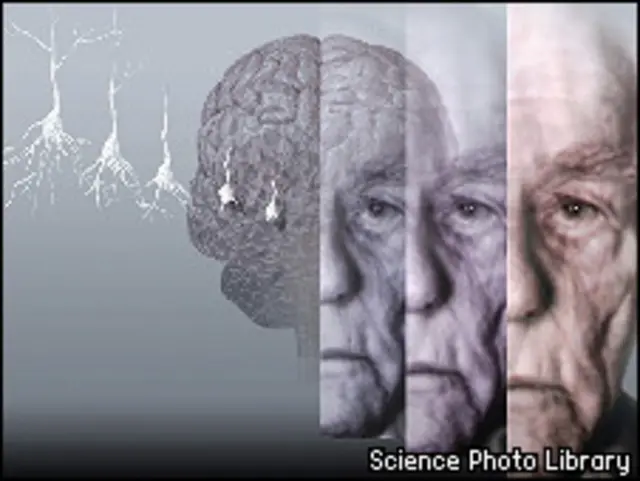 Альцгеймер