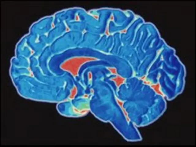 Томограмма головного мозга