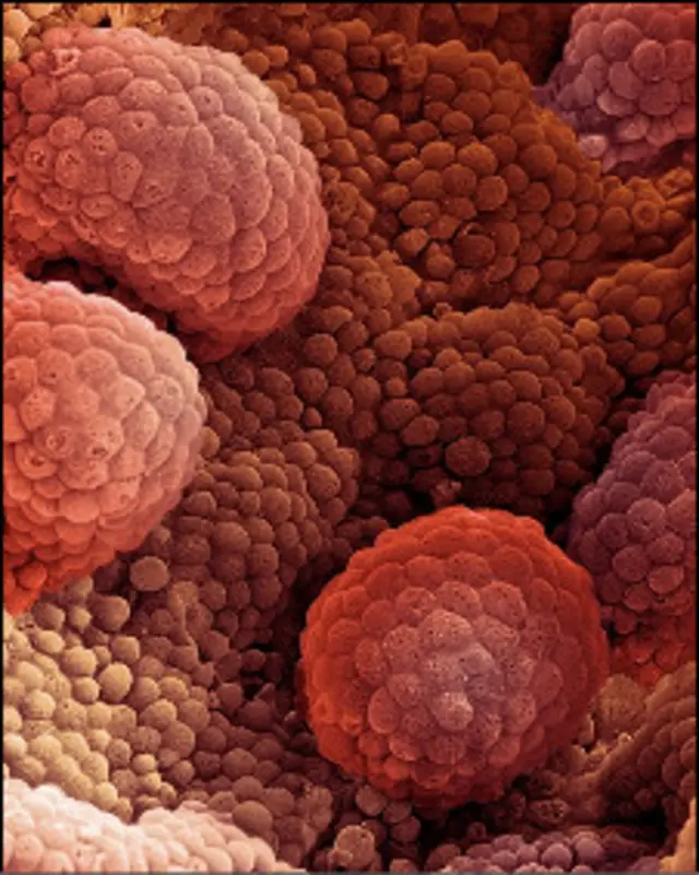 рак простаты