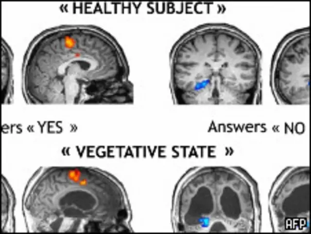 So sánh phản ứng não bộ thường với não người bệnh.