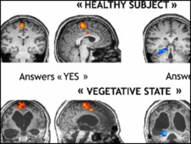 健康人大脑和植物人大脑的对比