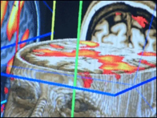 Kết quả chụp cho thấy một số bệnh nhân có nhận biết được.