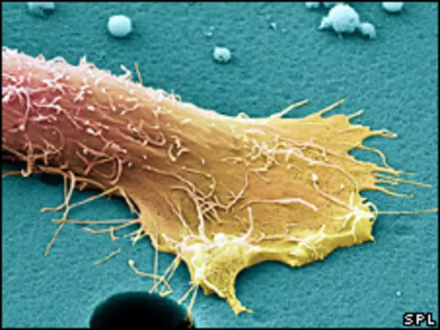 Prostat kanseri hücresi