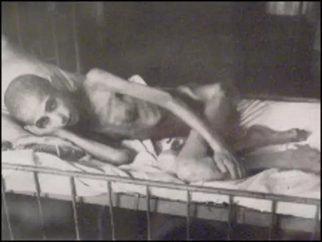 Женщина, больная дистрофией