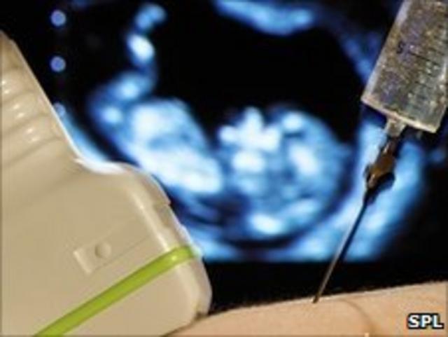 Prueba de amniocentesis