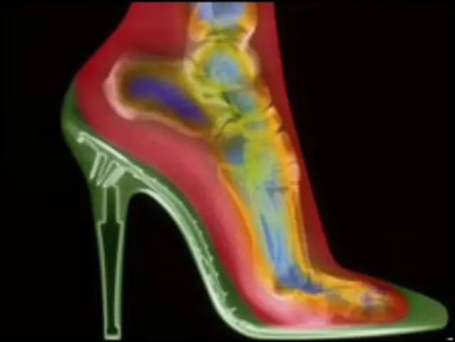 Sepatu hak tinggi bisa mempengaruhi otot betis