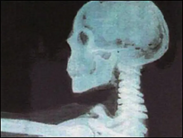 قد يساعد هذا الاكتشاف على تطوير ادوية افضل لسكري النمط الثاني