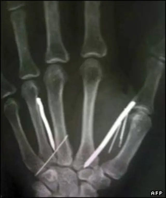 یکی از مسئولان بیمارستانی گفت طول میخ ها پنج سانتیمتر است