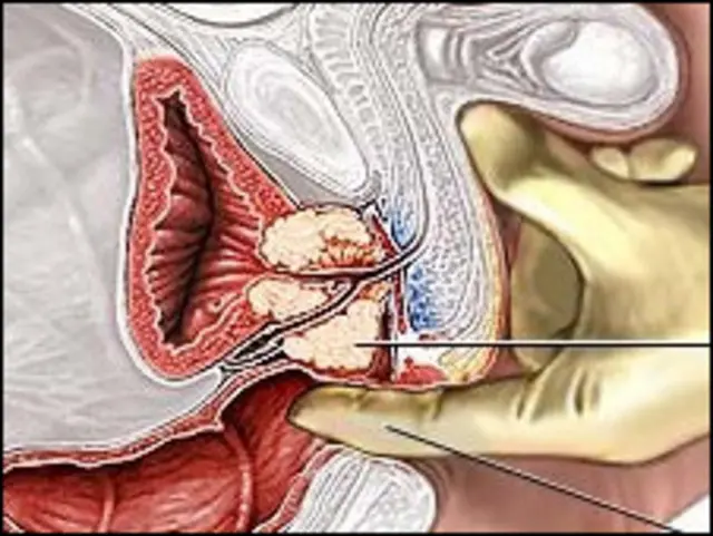 英国每年有一万男性死于前列腺癌