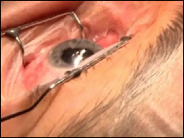 Офтальмологическая операция