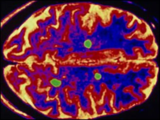 امید کی جا رہی ہے کہ سٹیم سیل انسانی دماغ تک پہنچ کر ایم ایس کی وجہ سے پہچنے والے نقصان کو درست کر دیں گے۔