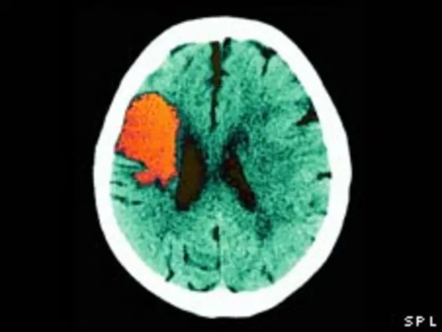 中风患者的脑部扫描图