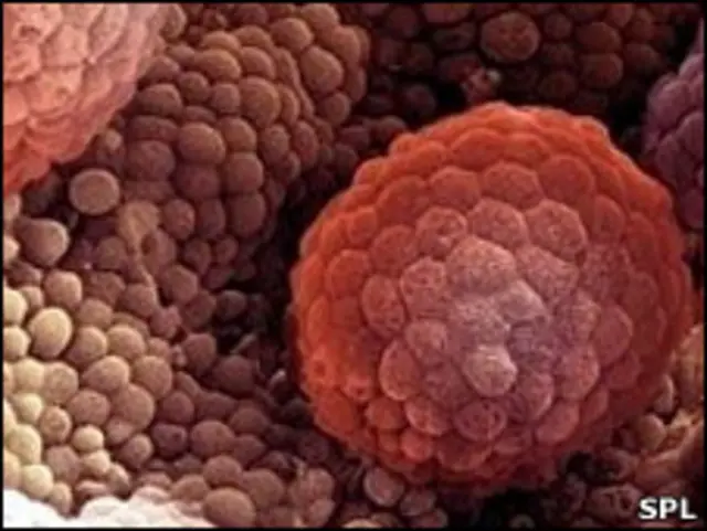 Рак простаты