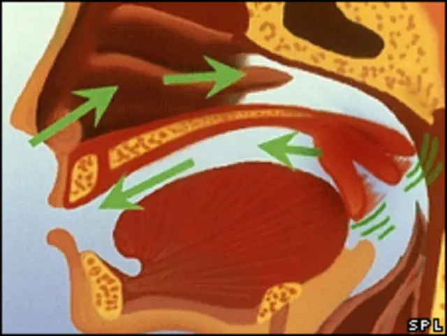 Ilustración de los ronquidos (SPL)