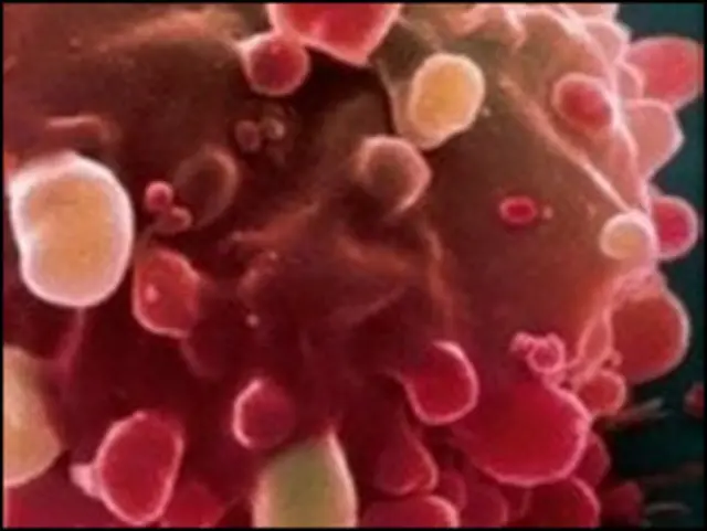 سلول سرطانی