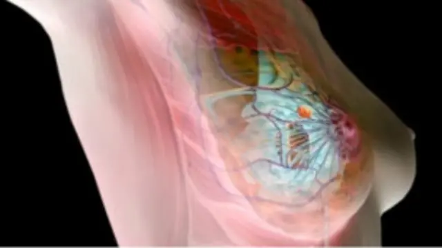 شیوع سرطان پستان در زنان ایرانی 