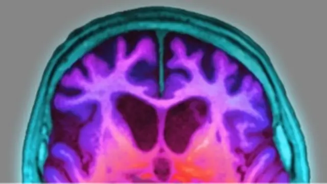 الزائمر کا مرض حافظہ کے مسائل کو جنم دیتا ہے جس سے سوچنے کی صلاحیت متاثر ہوتی ہے