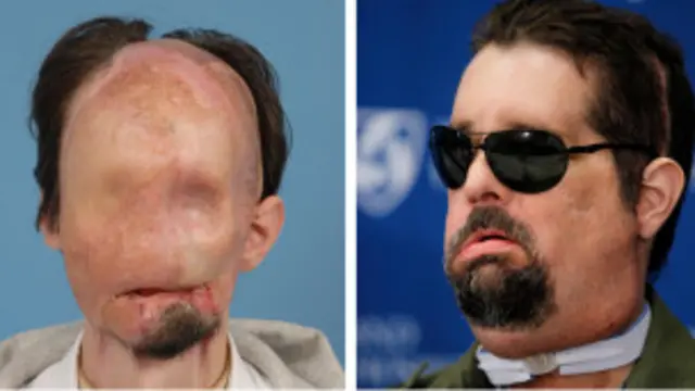 Dallas Wiens sebelum dan sesudah transplantasi wajah total.