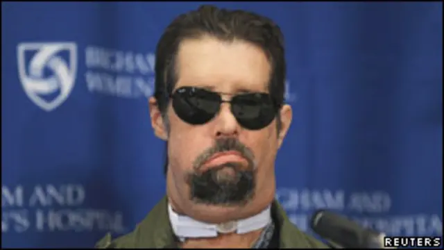 Мужчина с пересаженным лицом