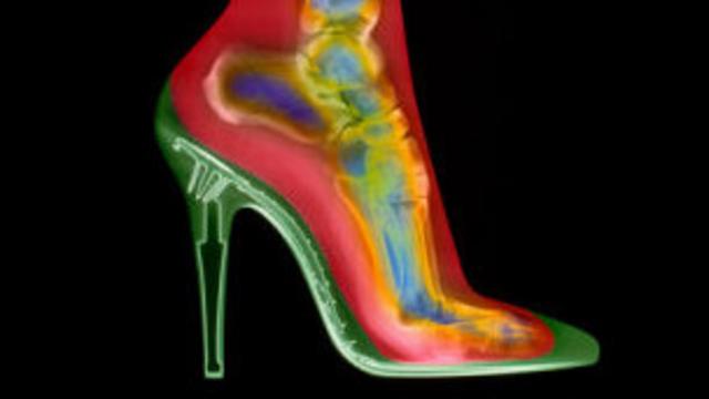Cuidado con los tacones y el riesgo de artritis BBC News Mundo