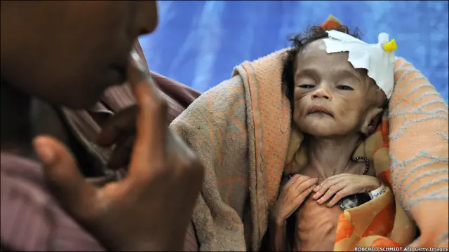 Двомісячна ефіопська дівчинка Бакалє у лікарні зі своєю мамою. В Ефіопії від бідності батьки продають дітей за кілька доларів. Потім дівчаток перепродують у сексуальне рабство за кордон, а хлопців - на важкі роботи. На перепродажі однієї дитини посередники заробляють до тисячі доларів. 