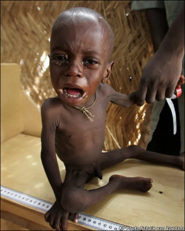 Цього нігерійського хлопчика привезли до лікарні, бо він страждає від недоїдання. 