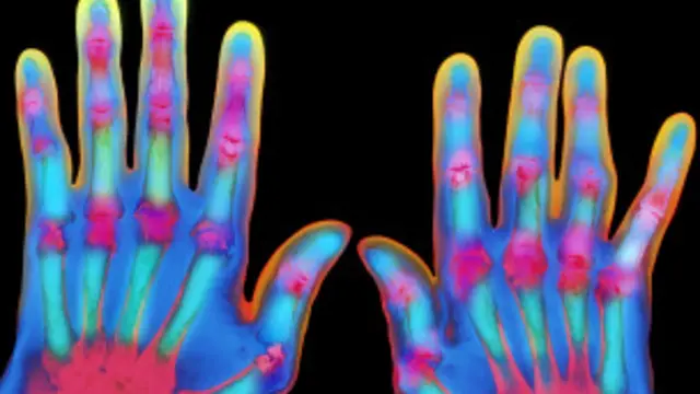 التهاب المفاصل