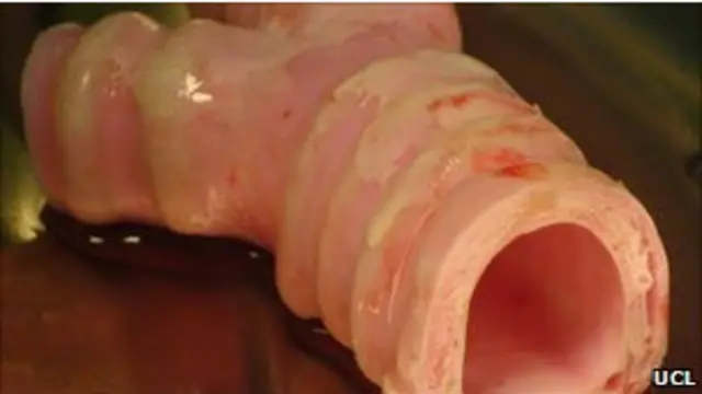 Искусственная трахея