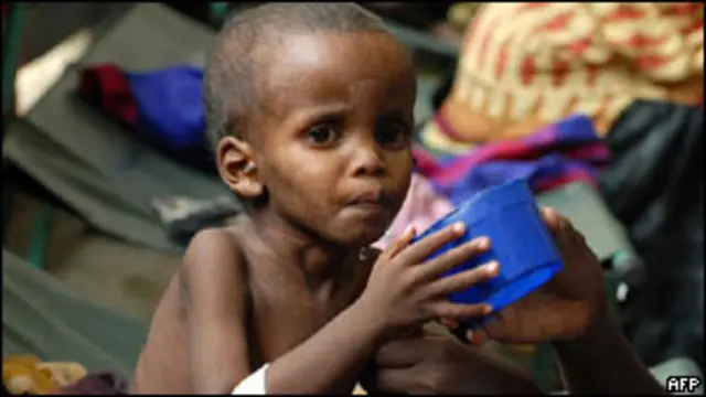 ஊட்டச்சத்து கிடைக்காத சொமாலிய பிள்ளை ஒன்று