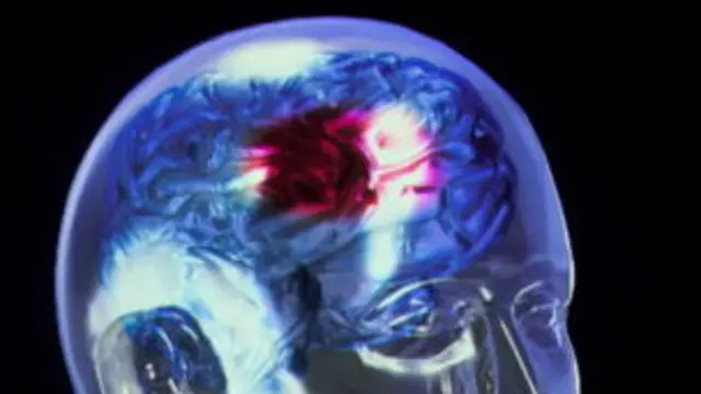 Daño de evento cerebrovascular