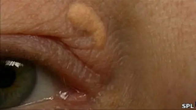 Ксантелазмы