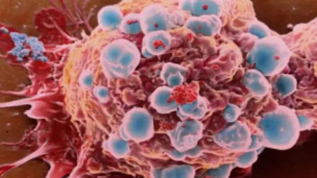 Célula cancerosa de mama